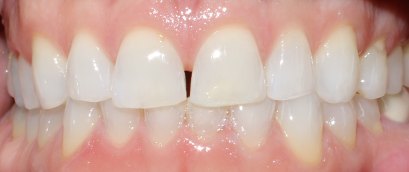 Stained and chipped tooth repair Novi, MI