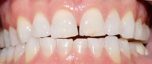 Stained and chipped tooth repair Novi, MI