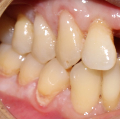 decayed carious lesions, cavities, gumline cavity Novi, MI