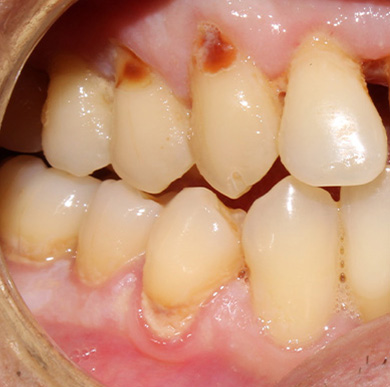 decayed carious lesions, cavities, gumline cavity Novi, MI